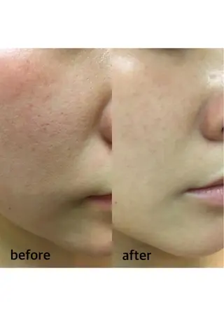 全身脱毛/韓国ツヤ肌 ハーブピーリングのエステ・リラクイメージ