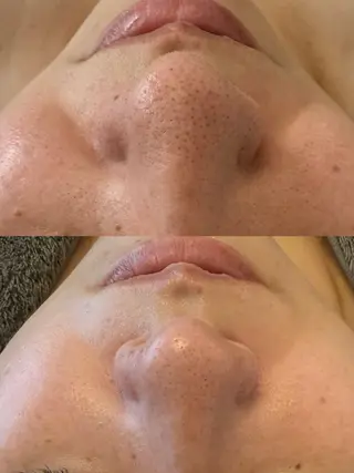 ニキビ・毛穴改善 🌿ハーブピーリングのエステ・リラクイメージ