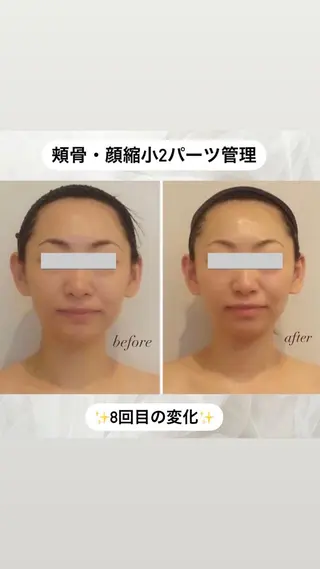 整形級の変化👀 最新✨韓国小顔管理のエステ・リラクイメージ