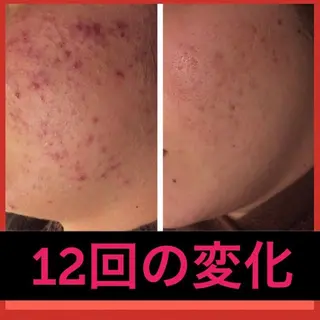 ミディアム パーマ ヘアアレンジ メンズ キッズ ネイル マツエク・マツパ ニキビ・肌質改善専門 ♡人生が変わるサロンのエステ・リラクイメージ