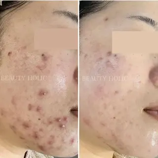 ニキビ・ 肌荒れ専門店のエステ・リラクイメージ