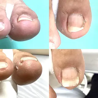 巻き爪補正店 大阪なんば店のネイルデザイン