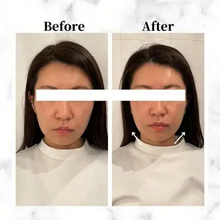 12Dハイフ💗 最強小顔のエステ・リラクイメージ