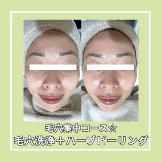 |ピーリング・毛穴| soina神楽坂のエステ・リラクイメージ