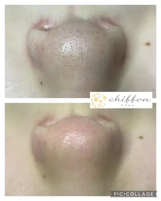 毛穴黒ずみ改善🥇 ✨シフォン豊田✨のエステ・リラクイメージ