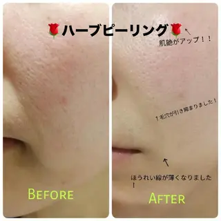 ハーブピーリング専門 毛穴洗浄❤️眉waxのエステ・リラクイメージ