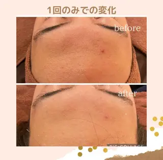 3か月で肌革命👼 ニキビ専門店💫のエステ・リラクイメージ