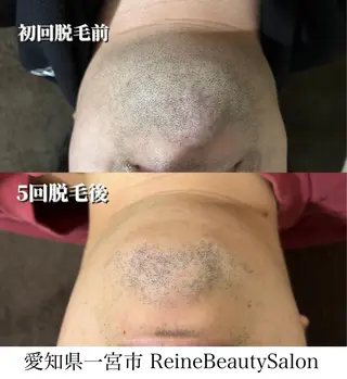 毛穴/シミ肝斑/脱毛 横山梨里のエステ・リラクイメージ