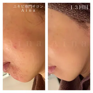 ロング カラー パーマ ヘアアレンジ メンズ キッズ ネイル マツエク・マツパ アイブロウ ニキビ跡専門サロン Ainaのエステ・リラクイメージ