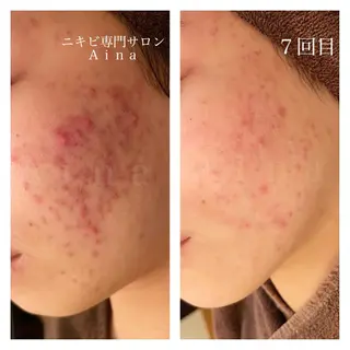 ミディアム カラー パーマ ヘアアレンジ メンズ キッズ ネイル マツエク・マツパ ニキビ跡専門サロン Ainaのエステ・リラクイメージ