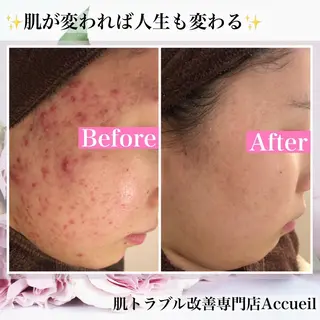 セミロング カラー パーマ ヘアアレンジ メンズ キッズ ネイル マツエク・マツパ アイブロウ 3か月で肌革命👼 ニキビ専門店💫のエステ・リラクイメージ