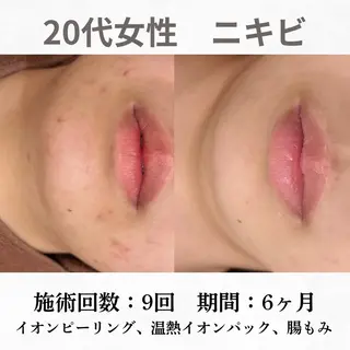 重度ニキビ専門🌷 ダウンタイムなしのエステ・リラクイメージ