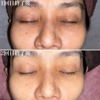 ロング カラー パーマ メンズ キッズ ネイル マツエク・マツパ アイブロウ 即小顔♥️美容鍼× ハーブピーリングのその他イメージ