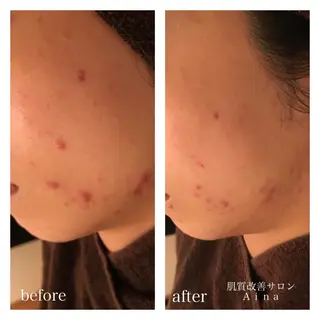 ミディアム カラー パーマ ヘアアレンジ メンズ キッズ ネイル マツエク・マツパ ニキビ跡専門サロン Ainaのエステ・リラクイメージ