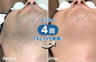 脱毛・毛穴洗浄 チルのエステ・リラクイメージ