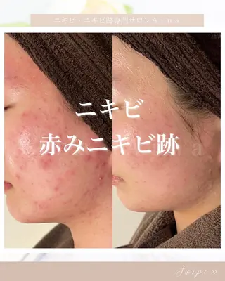ミディアム パーマ ヘアアレンジ メンズ キッズ ネイル アイブロウ ニキビ跡専門サロン Ainaのエステ・リラクイメージ