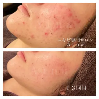 ロング パーマ ヘアアレンジ メンズ キッズ ネイル マツエク・マツパ アイブロウ ニキビ跡専門サロン Ainaのエステ・リラクイメージ