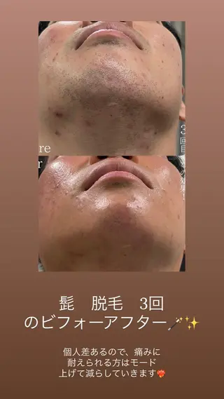 KARIN/りあみか /眉毛/まつげ/脱毛のマツエク・マツパデザイン