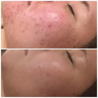ミディアム カラー パーマ ヘアアレンジ キッズ ネイル マツエク・マツパ アイブロウ 3か月で肌革命👼 ニキビ専門店💫のエステ・リラクイメージ