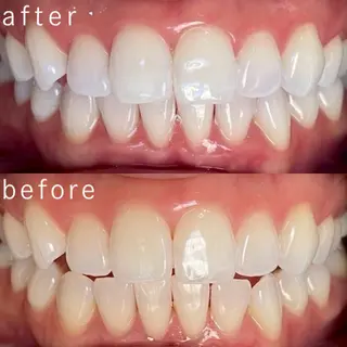 セルフホワイトニング 都立大学🦷✴︎のその他イメージ