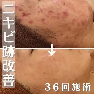 ロング カラー パーマ ヘアアレンジ メンズ キッズ ネイル マツエク・マツパ アイブロウ 3か月で肌革命👼 ニキビ専門店💫のエステ・リラクイメージ
