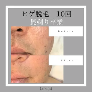 脱毛サロン Lokahiのエステ・リラクイメージ