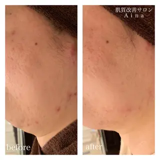 セミロング カラー パーマ ヘアアレンジ メンズ キッズ ネイル マツエク・マツパ ニキビ跡専門サロン Ainaのエステ・リラクイメージ