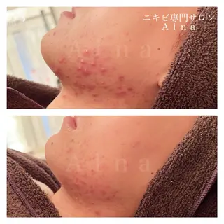 セミロング パーマ ヘアアレンジ メンズ キッズ ネイル マツエク・マツパ アイブロウ ニキビ跡専門サロン Ainaのエステ・リラクイメージ