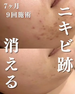 3か月で肌革命👼 ニキビ専門店💫のエステ・リラクイメージ