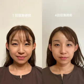 即小顔♥️美容鍼× ハーブピーリングのその他イメージ