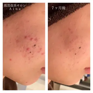 セミロング カラー パーマ ヘアアレンジ メンズ キッズ ネイル マツエク・マツパ ニキビ跡専門サロン Ainaのエステ・リラクイメージ