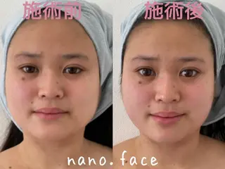 マツエク・マツパ nano.face名古屋駅前店所属・美容鍼/小顔&整体 nano.faceのエステ・リラクイメージ