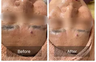 ハーブピーリング Lanaのエステ・リラクイメージ