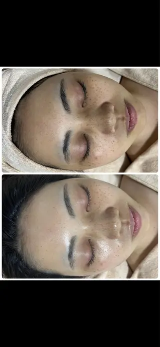 ニキビ／毛穴ケア ハーブピーリングのエステ・リラクイメージ