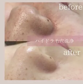 角質・毛穴洗浄🌼 脱毛🌸嶋津弘美のエステ・リラクイメージ