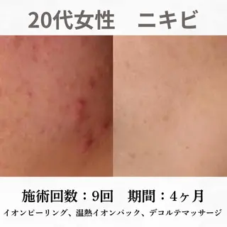 重度ニキビ専門🌷 ダウンタイムなしのエステ・リラクイメージ