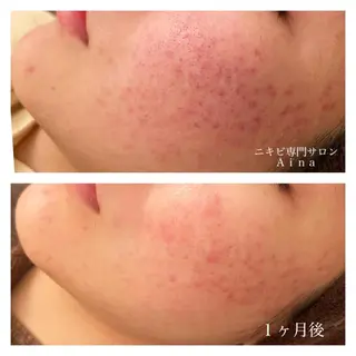 セミロング カラー パーマ ヘアアレンジ メンズ キッズ ネイル マツエク・マツパ ニキビ跡専門サロン Ainaのエステ・リラクイメージ