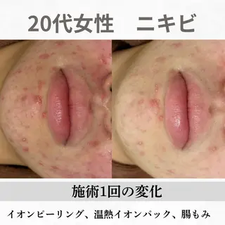 重度ニキビ専門🌷 ダウンタイムなしのエステ・リラクイメージ
