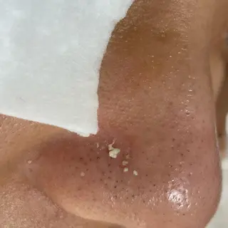 毛穴ケア・肌質改善 徳川のエステ・リラクイメージ