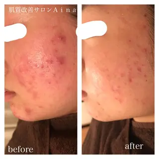 ミディアム ヘアアレンジ キッズ ネイル マツエク・マツパ ニキビ跡専門サロン Ainaのエステ・リラクイメージ