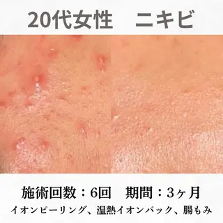 重度ニキビ専門🌷 ダウンタイムなしのエステ・リラクイメージ