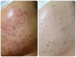 Auguspa〜オーガスパ〜所属・つるんとむき卵肌に 🌟ハーブピーリングのエステ・リラクイメージ