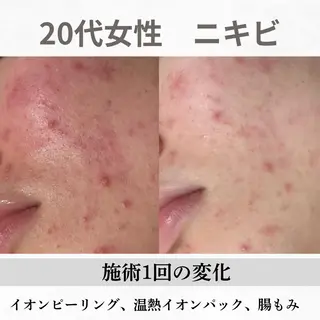 重度ニキビ専門🌷 ダウンタイムなしのエステ・リラクイメージ