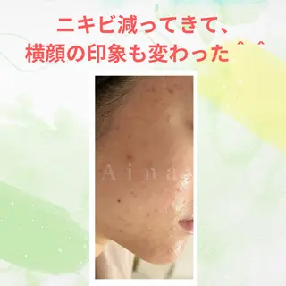 ニキビ跡専門サロン Ａｉｎａのエステ・リラクイメージ