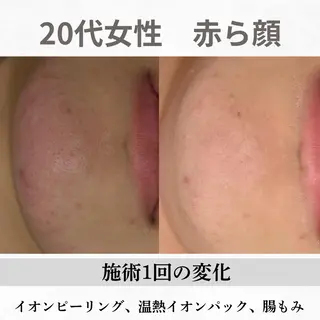 重度ニキビ専門🌷 ダウンタイムなしのエステ・リラクイメージ