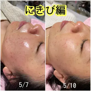 WAX・肌質改善・毛 穴洗浄/林愛真のエステ・リラクイメージ