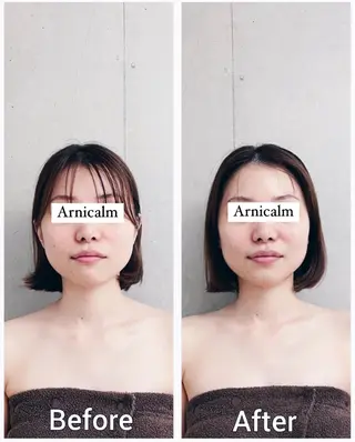 ハーブピーリング 肌再生ピーリング/のエステ・リラクイメージ