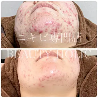 ニキビ・ 肌荒れ専門店のエステ・リラクイメージ