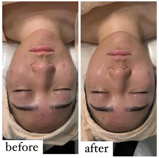 【ハーブピーリング】 Allumentのエステ・リラクイメージ