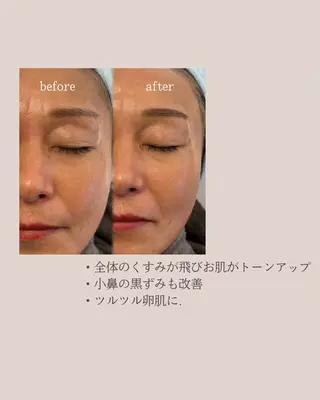Lea堺東　毛穴洗浄 ×顔ワックス脱毛のエステ・リラクイメージ